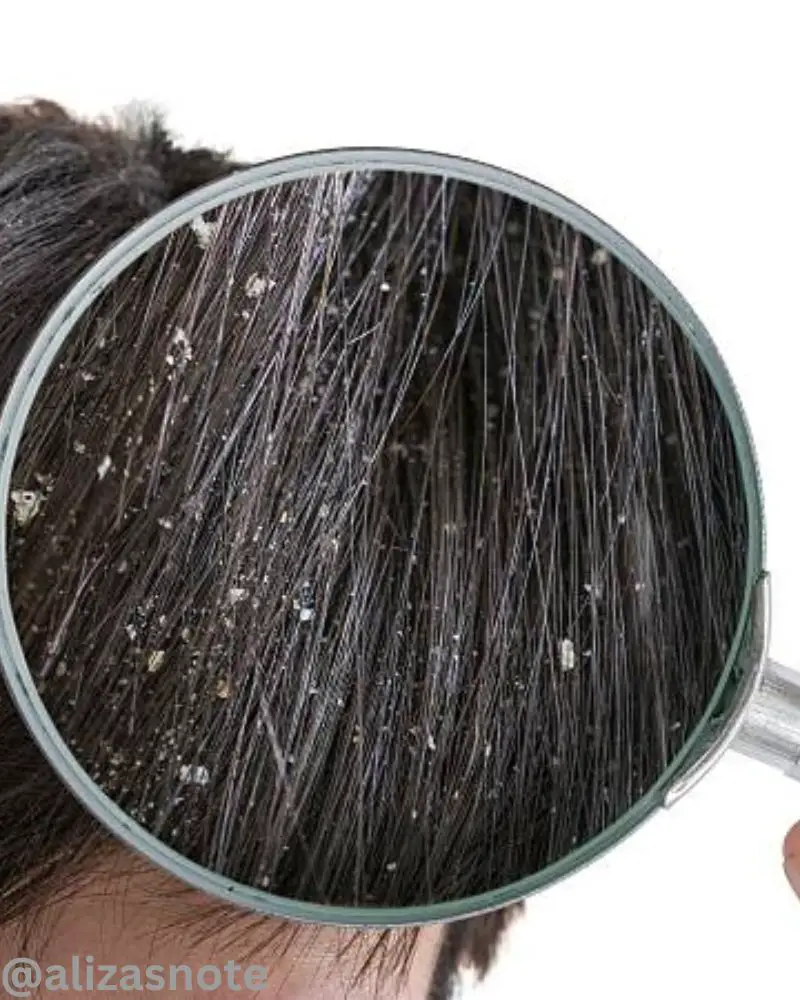 How to remove dandruff in one wash at home