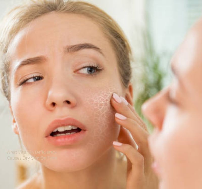 What Vitamin Deficiency Causes Dry Skin On Face