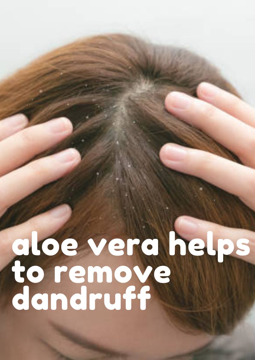 does aloe vera helps to remove dandruff
