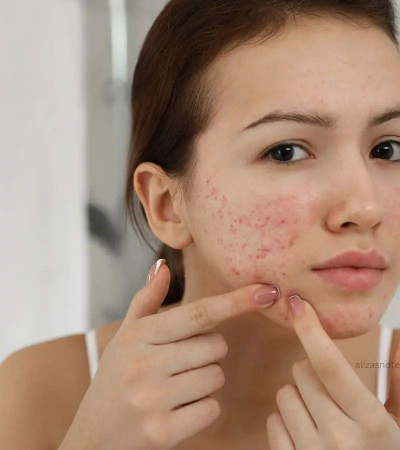 Acne Prone Skin care