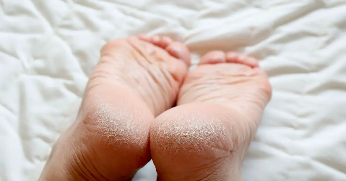 Home Remedy For Severely Cracked Heels