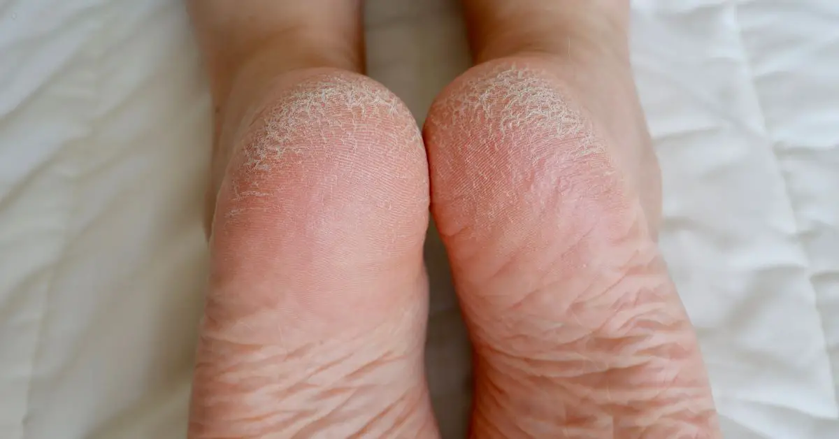 How To Heal Cracked Feet Overnight Home Remedies