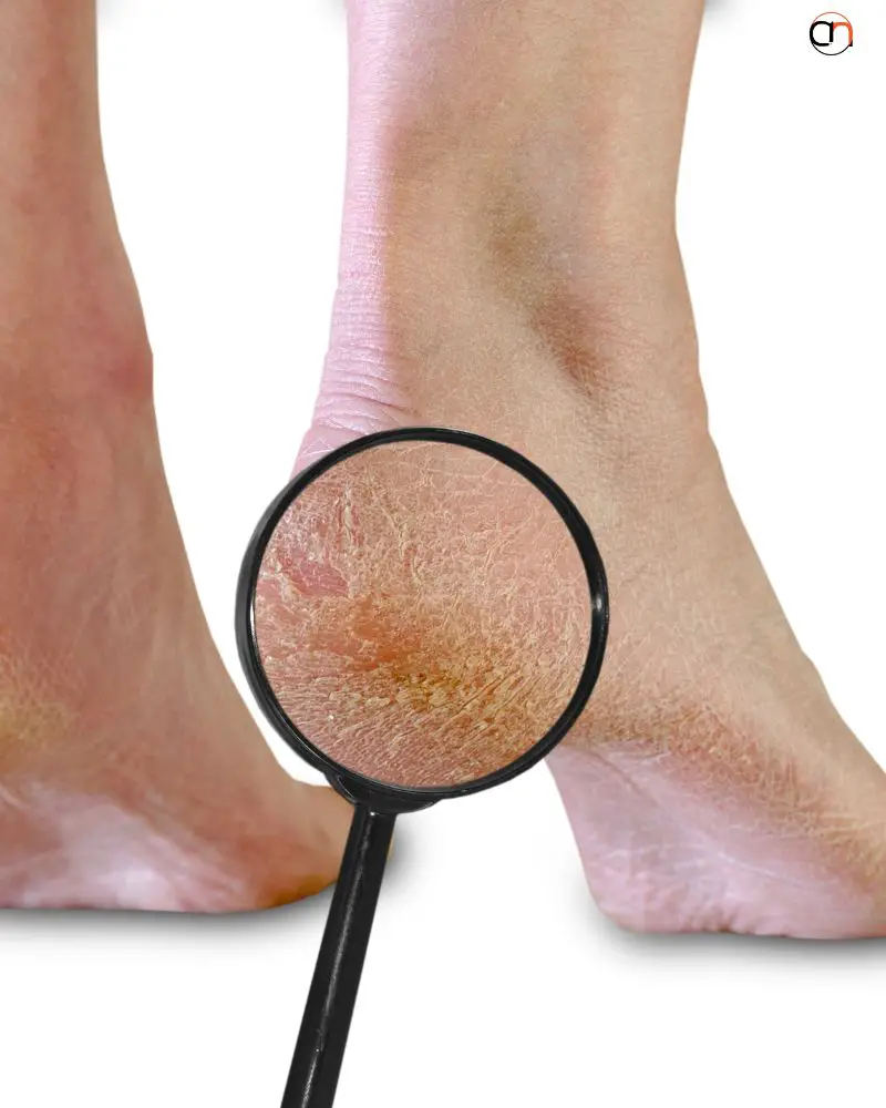 home remedies for badly cracked feet