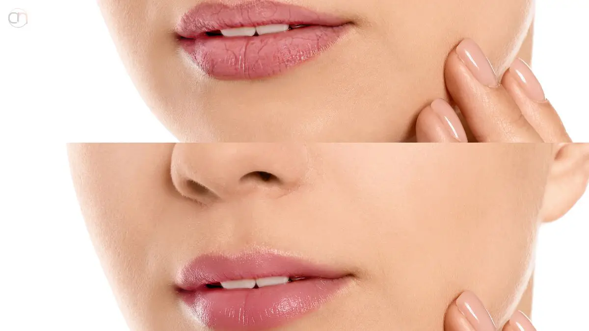 Dry Lips Treatment Overnight