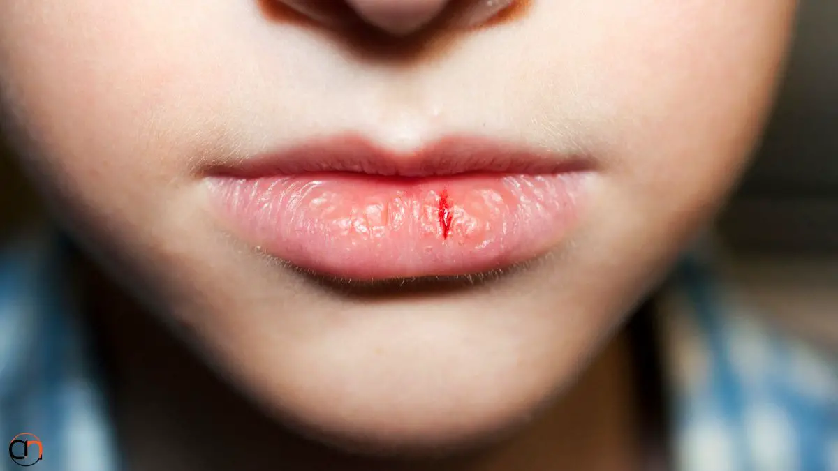 Dry Lips Winter Home Remedies