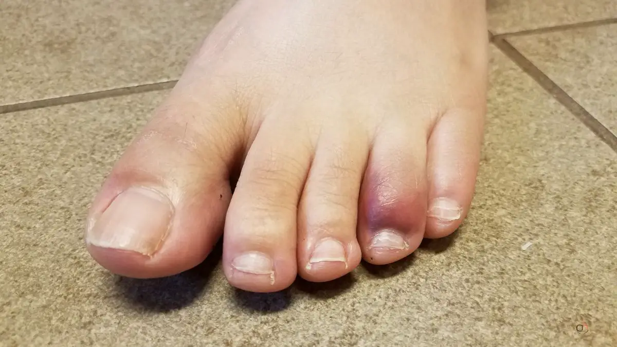 How Long Do Bruises On Toenails Last