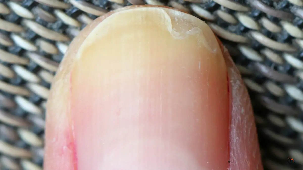 What Causes Fingernails To Split Down The Middle