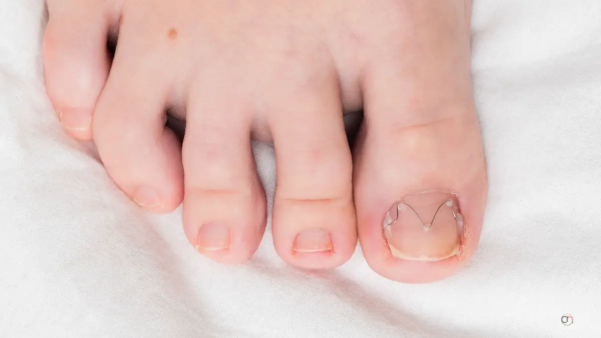 what should you do if your toenail cracked in half